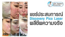 แชร์ประสบการณ์ Discovery Pico Laser พลีชีพความจริง